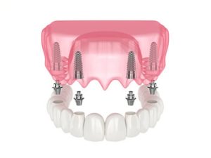 all 4 dental implants cost illustration glenmore park