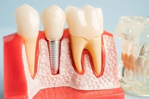 Dental Bone Graft Recovery implant Dental Bone Graft Recovery implant