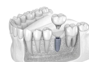 illustration-of-the-stages-of-osseointegration-with-the-titanium-screw-fusing-with-the-jawbone illustration of the stages of osseointegration with the titanium screw fusing with the jawbone