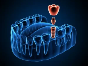 3d illustration of a dental implant abutment and crown in a jawbone cross section 3d illustration of a dental implant abutment and crown in a jawbone cross section