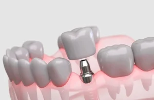anatomical diagram showing the difference between a healthy tooth and a dental implant anatomical diagram showing the difference between a healthy tooth and a dental implant