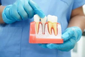 dental professional showing dental implant model dental professional showing dental implant model