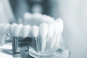 dental implants illustration model dental implants illustration model